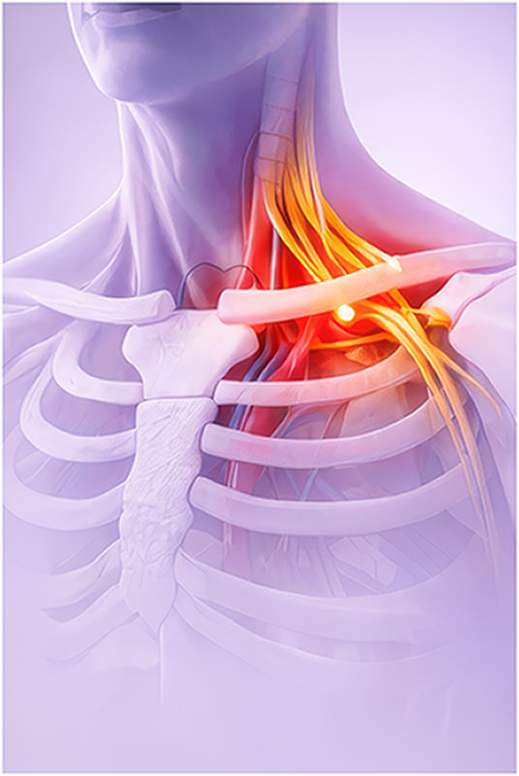 Torasik Outlet Sendromu